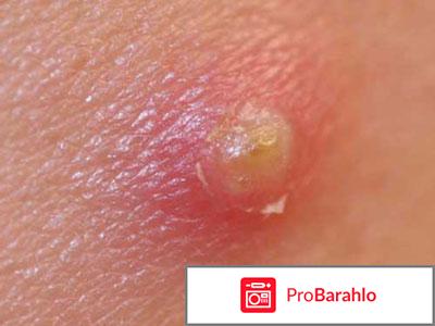 Фурункул на интимных местах лечение в домашних условиях 