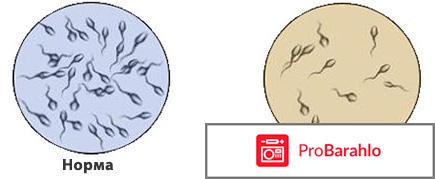 Азооспермия лечение отзывы у мужчин 