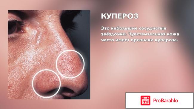 Крем от купероза на лице отзывы отрицательные отзывы