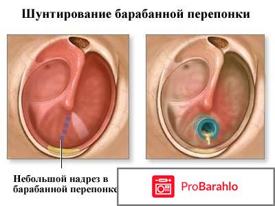 Отит у детей отрицательные отзывы