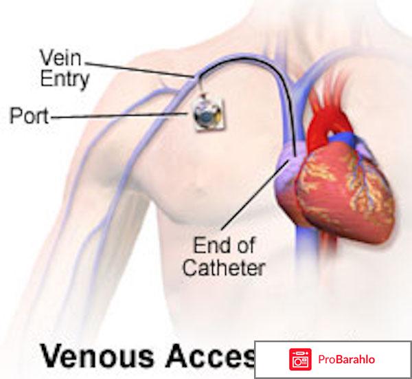 Имплантируемые порт-системы port-a Cath 