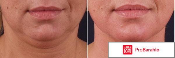 Липолитики для похудения фото отрицательные отзывы