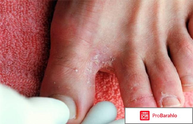 Канизон мазь инструкция по применению цена отзывы отрицательные отзывы