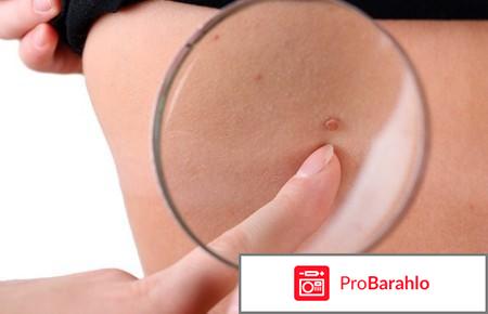 Папиловит (Papilovit) фото