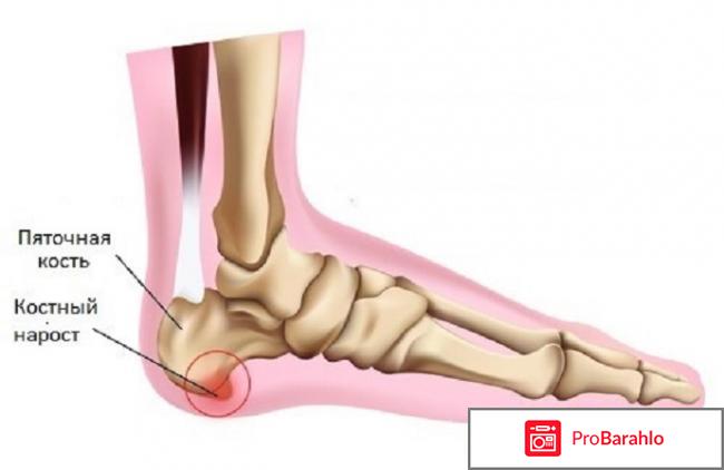 Отложение солей в пятках лечение 