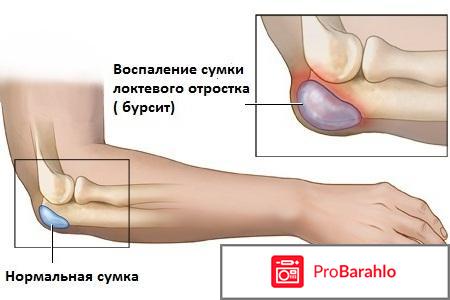Румалон инструкция по применению цена аналоги отрицательные отзывы