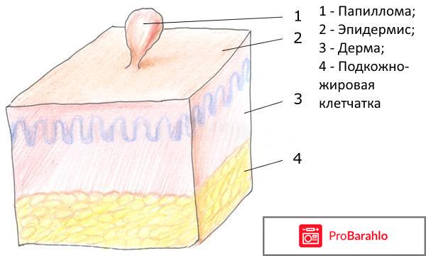 Папилломы на шее: причины появления и способы отрицательные отзывы