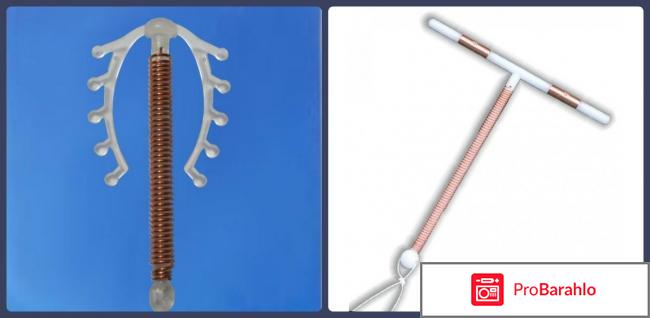 Внутриматочная спираль отзывы врачей 