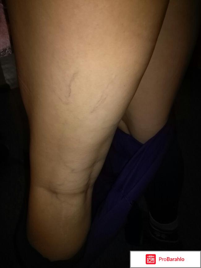 Вариус цена в аптеках отрицательные отзывы