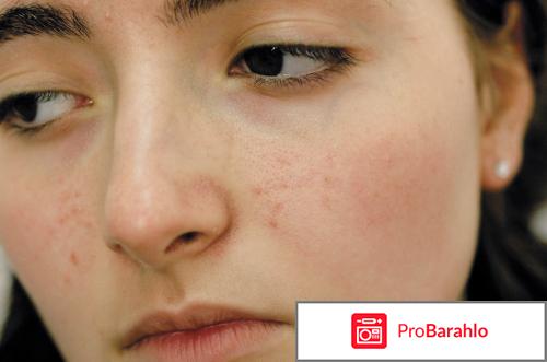 Как убрать следы от прыщей на лице 