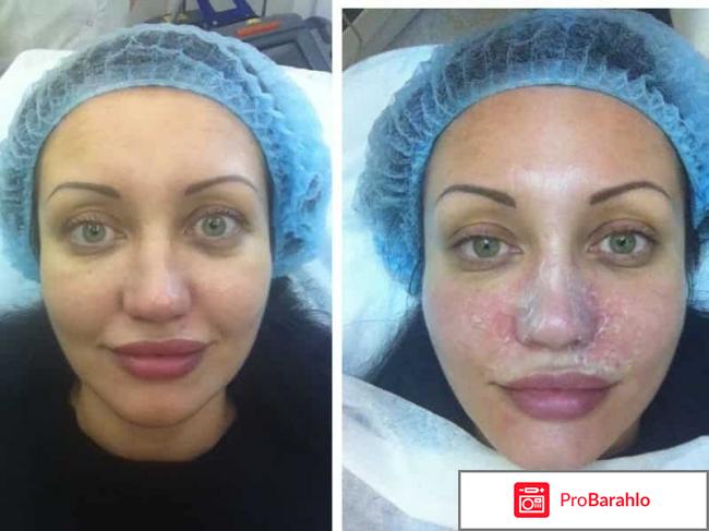 Плазмолифтинг лица отзывы отрицательные 