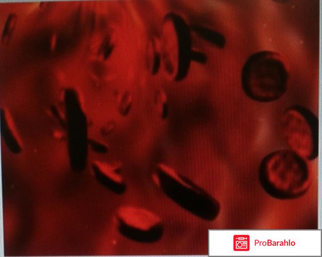 Гемоглобин у женщин, норма, анемия 