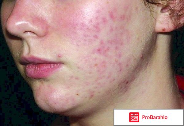Андрогенное акне обман