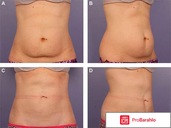 Криолиполиз отзывы фото до и после цена 