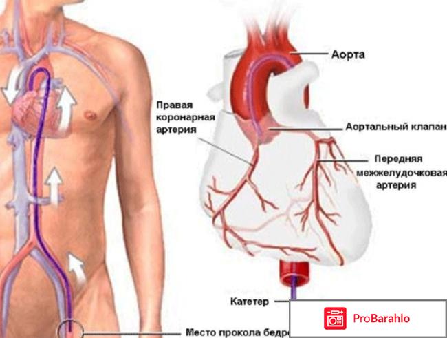 Коронарография (через бедренную артерию) 