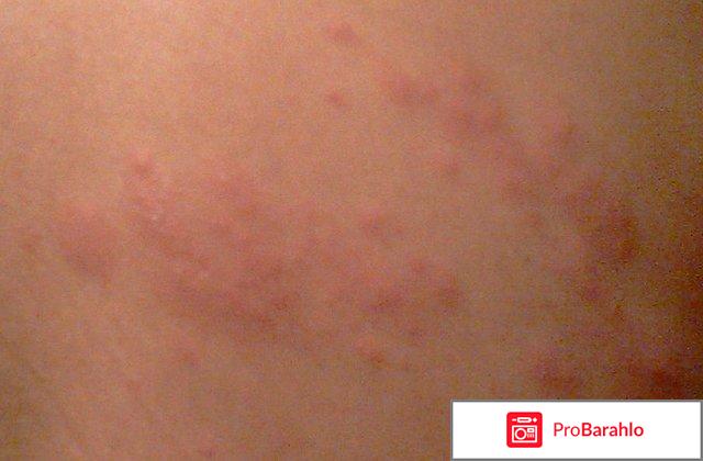 Опоясывающий герпес: причины, симптомы, лечение 