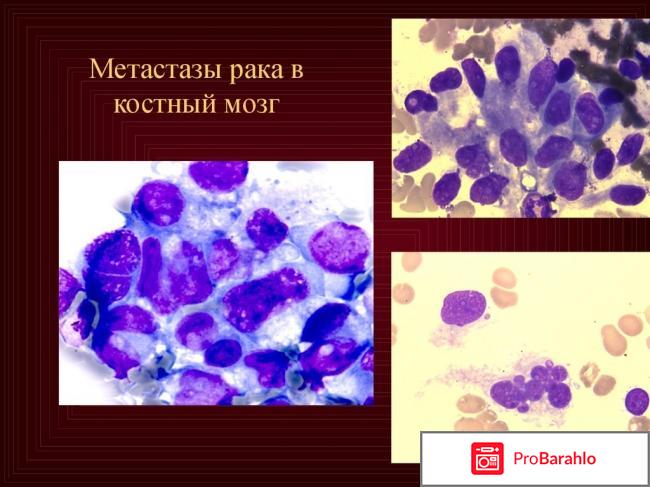 Миелограмма костного мозга отрицательные отзывы