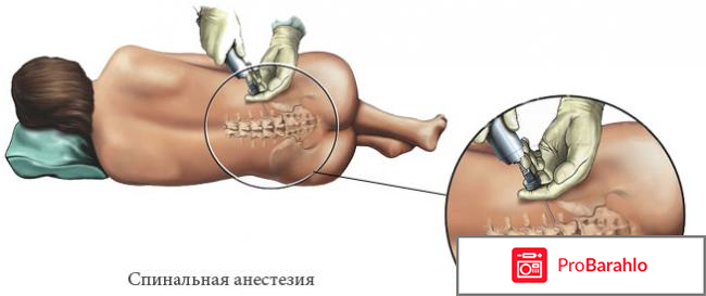 Какой наркоз лучше при кесаревом сечении отзывы 