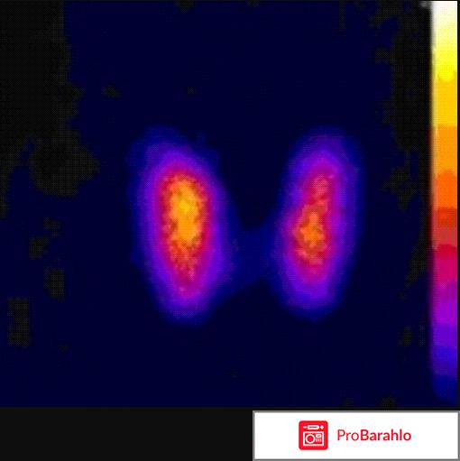 Функциональная активность щитовидной железы отрицательные отзывы
