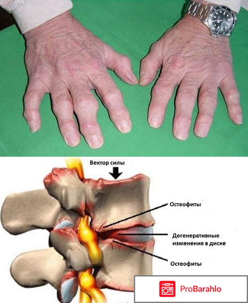 Отложение солей в суставах лечение народными средствами обман