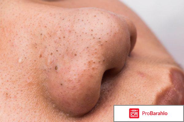 Как избавиться от комедонов на лице в домашних условиях 