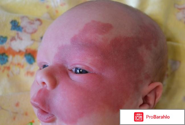 Тимолол глазные капли инструкция цена отзывы реальные отзывы