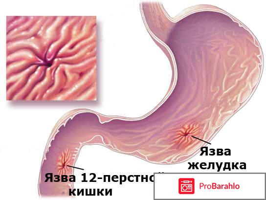 Схема лечения язвы 12 перстной кишки препараты 