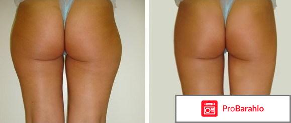 Криолиполиз отзывы фото до и после цена обман