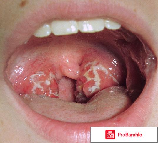 Лакунарная ангина осложнения обман