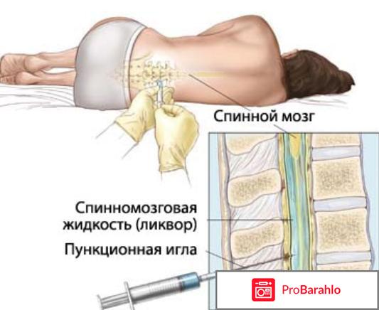Люмбальная пункция показания и противопоказания 