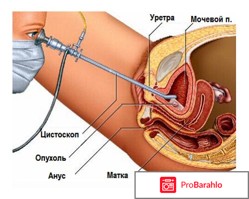 Цистоскопия отзывы о процедуре у женщин 