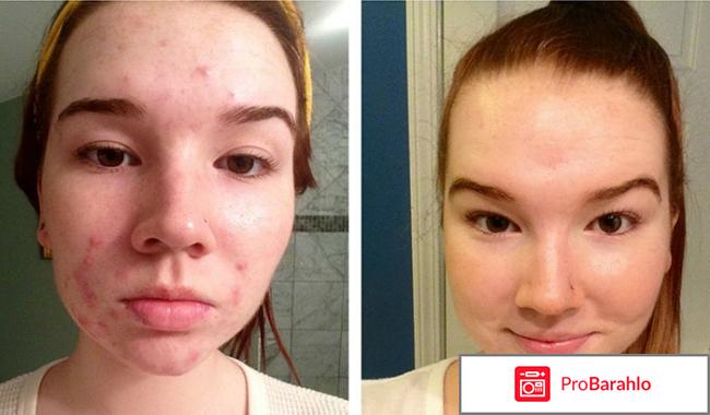 Препарат роаккутан обман