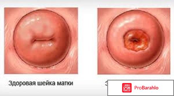 Эрозия шейки матки отзывы женщин обман