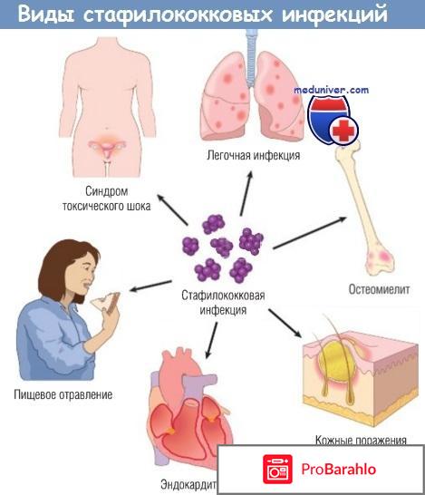 Стафилококк: способы заражения, лечение, профилактика 