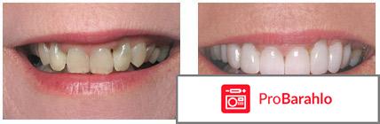 Эстетическая реставрация зубов отрицательные отзывы