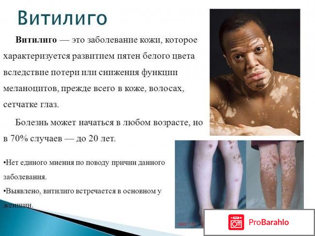 Витилиго лечение 2017 лекарство отзывы отрицательные отзывы