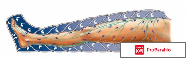 Отзывы о прессотерапии 