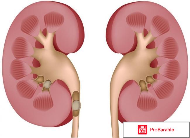 Цистон отзывы при мочекаменной болезни у женщин отзывы владельцев