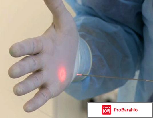 Лазерная липосакция отзывы