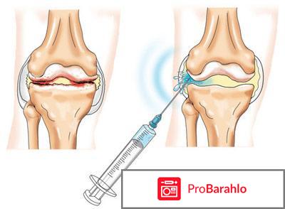 Плазмолифтинг суставов отзывы отрицательные 