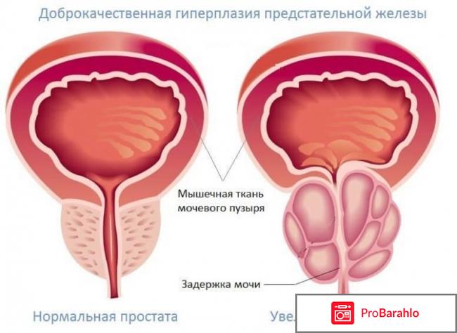 Аденома простаты у мужчин симптомы лечение отзывы 