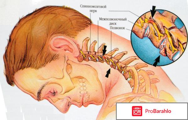 Лечение остеохондроза шейного отдела позвоночника 