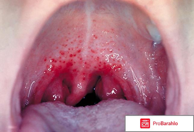Красное горло у ребенка лечение 