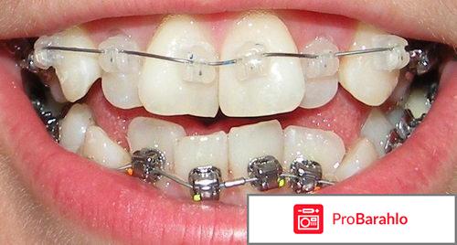 Damon брекеты обман