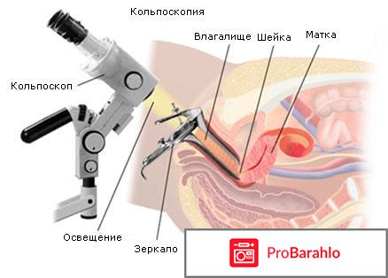 Кольпоскопия отрицательные отзывы