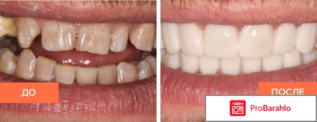 Виниры отзывы отрицательные обман