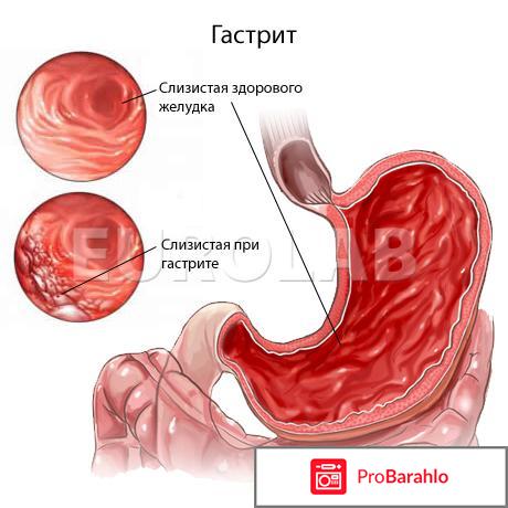 Гастрит у ребенка обман