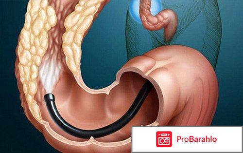 Диагностика заболеваний кишечника обман