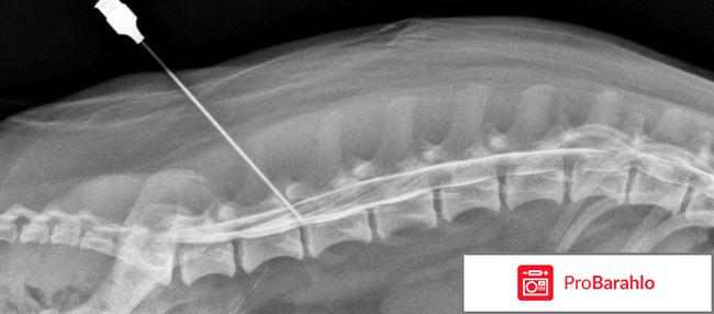 Блокады при остеохондрозе отрицательные отзывы