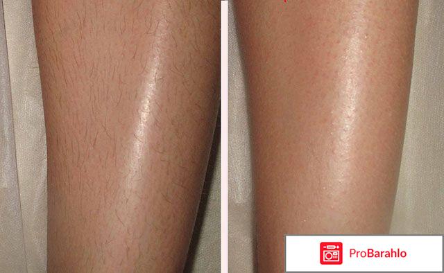 Лазерная депиляция отрицательные отзывы